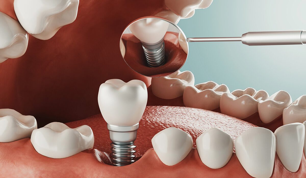 How Dental Implants in Tunbridge Wells Can Transform Your Smile